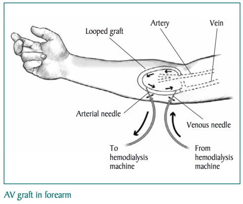 AV Graft In Forearm