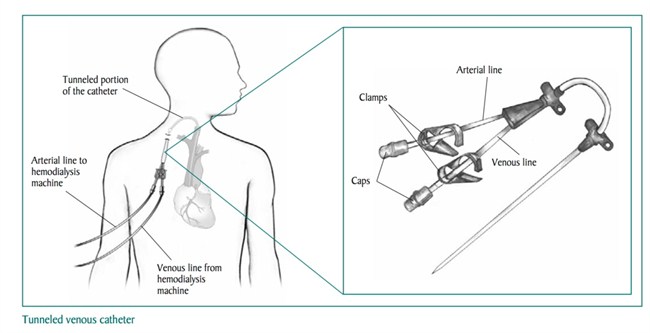 Tunneled Venous Catheter